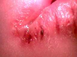 Befallene Lippen, 10 fach vergrert. Bildquelle: www.morgellons.org#Morgellons2.htm
